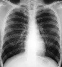 Characteristics of Chronic Pulmonary Aspergillosis: Review of Cases