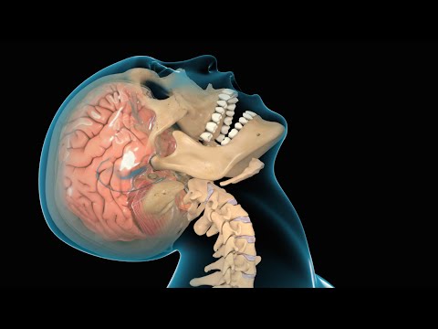 Diffuse Brain Injury-Review of Literature and Representative Case Reports