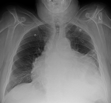 A Case of Pericardial Effusion and Cardiac Tamponed with Hyperthyroidism