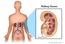 Investigating the Factors Relevant to Kidney Stone in Patients at Amir al-Muminin Hospital in Zabol City in 2017-2018