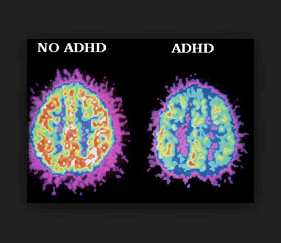 Correlation between Attention Deficit Hyperactivity Disorder and Giggle Incontinence