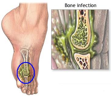 Osteomyelitis of the Middle Distal Phalanx Caused by Arcanobacterium haemolyticum in an Adolescent Nail Biter