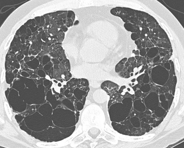 BRAF Mutations in Pulmonary Langerhans Cell Histiocytosis: A Multicentre Survey