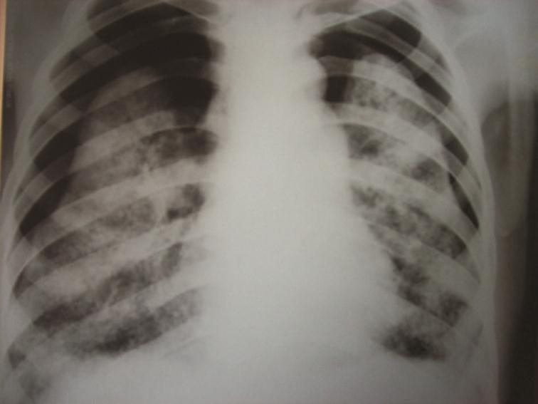 Sporadic Lymphangioleiomyomatosis Presented with Bilateral Pneumothorax