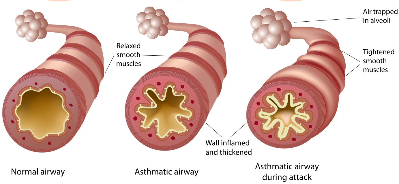 Finding a Fitting Ending for Asthma