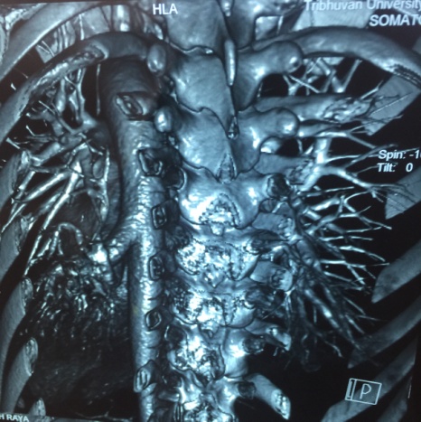 Descending thoracic aorta to left pulmonary vein fistula associated with mitral regurgitation: A rare combination