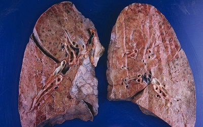 Clinical Practice Variability in the Management of Patients with Alveolar Proteinosis