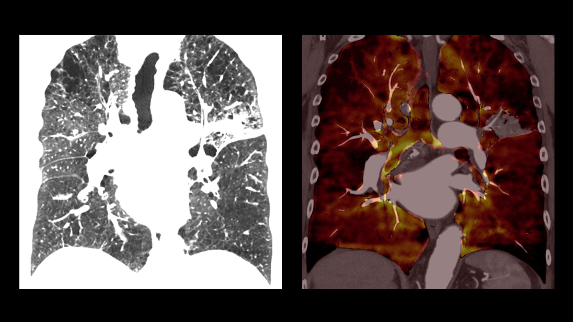 The New Generation of the ExVivo Lung Perfusion Systems