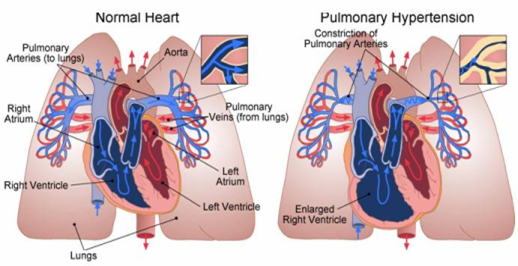 The Use of Citrulline for Pediatric Pulmonary Hypertension