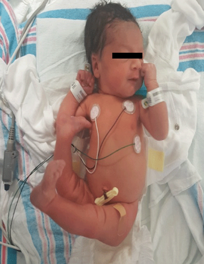 Congenital Bilateral Knee Hyperextension in a Well-Newborn Infant