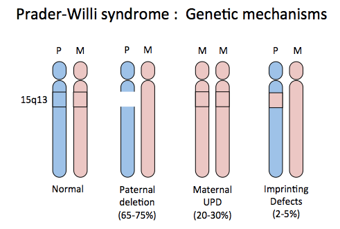 Sleep Disordered Breathing in Prader-Willi Syndrome: A Review