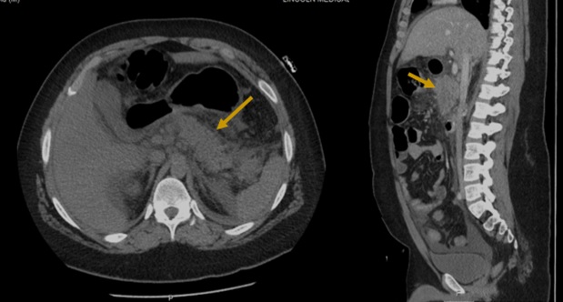 Drug induced Acute Pancreatitis in an Adolescent with Seizure Disorder and Autism