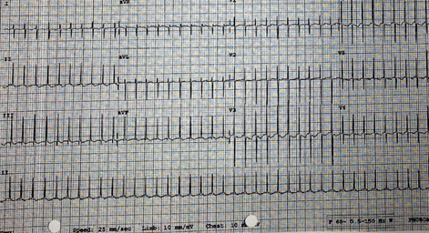 Fetal Tachycardia as Neonatal Atrial Flutter in Infant of Diabetic Mother (IDM): A Case Report