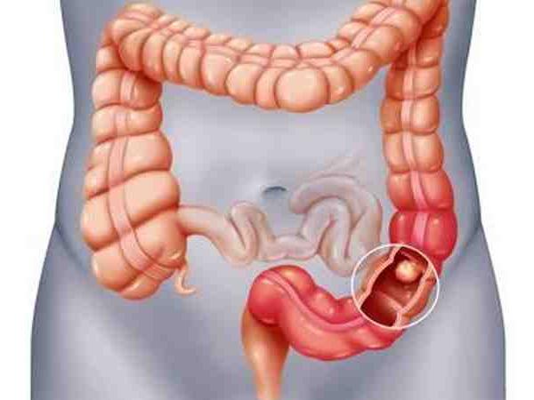 Colorectal Cancer