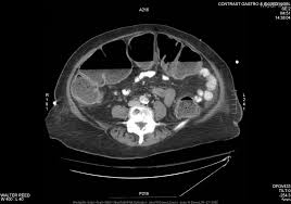 Toxic Megacolon: Management Challenges