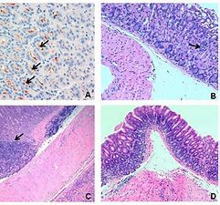 The Relation between Helicobacter Pylori Infection, Serum Ammonia and Hepatic Encephalopathy in Yemeni Cirrhotic Patients