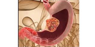 Gastrointestinal Stromal Tumors