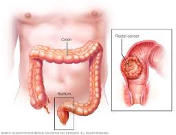 Cancers of Colon and Rectum