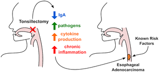 Gastroesophageal Reflux GWAS
Identifies Risk Loci that also
associate with Subsequent Severe
Esophageal Diseases