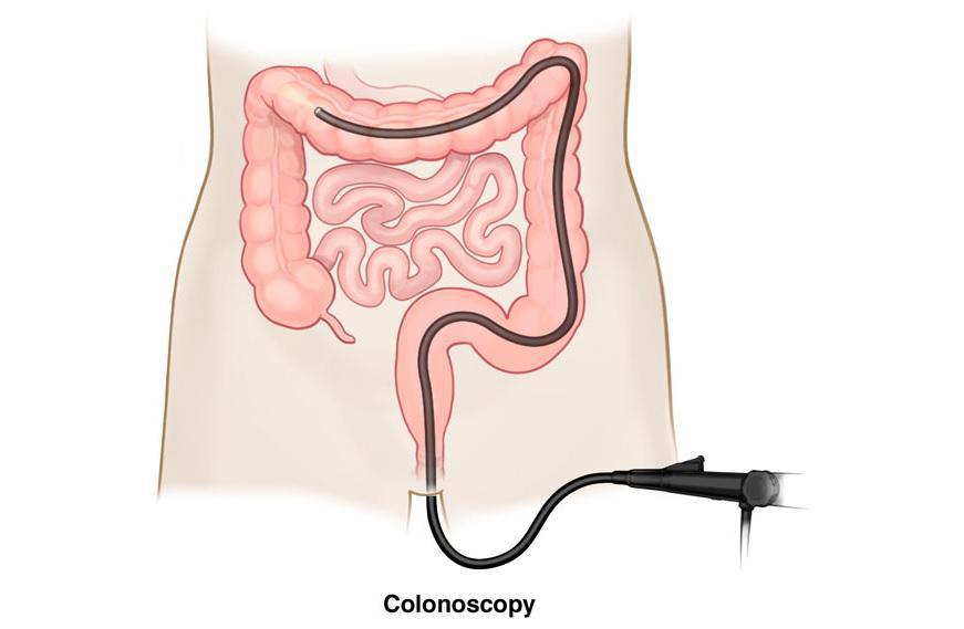 Role of Colonoscopy in Preventing Colorectal Cancer