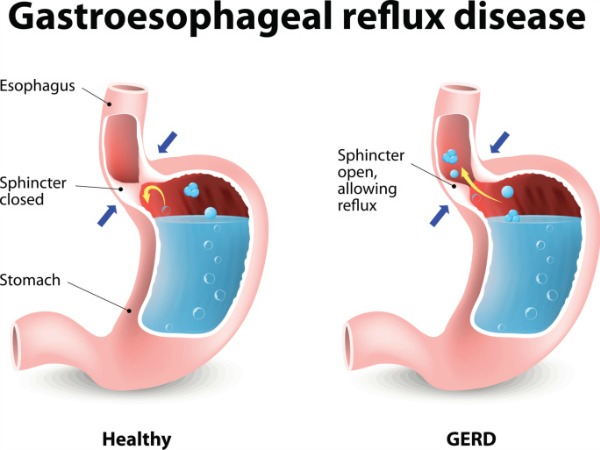 Gastro esophageal reflux disease