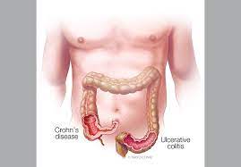 Ulcerative Colitis and Crohn Disease