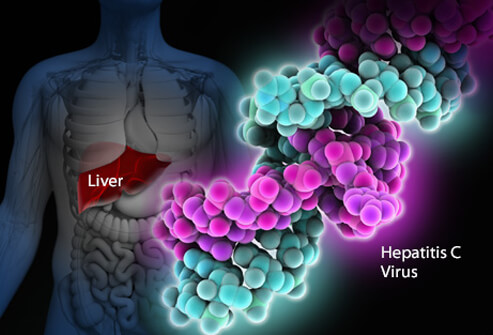 Hepatitis C Infection and Paroxysmal Nocturnal Hemoglobinuria with Complicated Course: Coincidental Association or True Link?