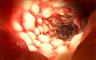 Crohns Colitis with Marked Peripheral Eosinophilia