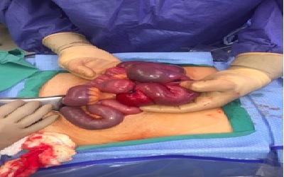 Inverted Meckels Diverticulum as the cause of Intussusception in Adults