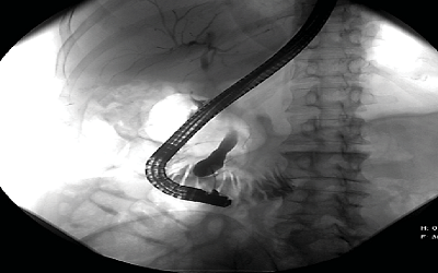 Successful Biliary Navigation Using Air in Malignant and Post-Surgical Hilar Strictures: A Prospective Controlled Trial