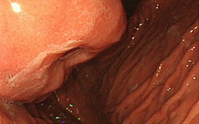 Gastric Schwannoma: A Rare Case with Preoperative Diagnosis by EUS-FNB