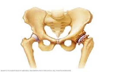 Early Stage Hip Osteoarthritis is Associated with Specific Muscle Weakness